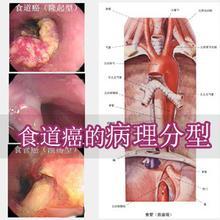 食管肿瘤的临床分期